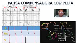 🅿🅰🆄🆂🅰 compensadora 🅲🅾🅼🅿🅻🅴🆃🅰 en extrasístole Ventricular Análisis del Ekg mecanismo y Escaleligrama [upl. by Nivek628]