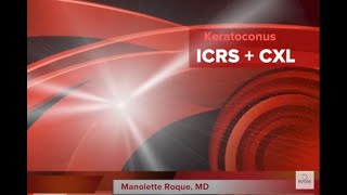 Keratoconus  Keraring ICRS  Corneal Collagen CrossLinking CXL [upl. by Akyre]