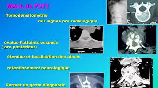 traumatologie GENERALITE SUR LA TUBERCULOSE OSSEUSE ET OSTEO ARTICULAIRE [upl. by Safir]