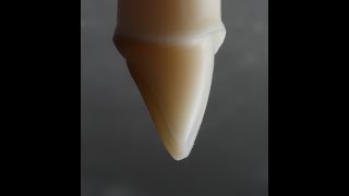 All Ceramic Crown Preparation for Emax and Zirconia [upl. by Eiahpets]