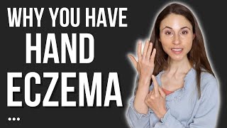 THIS IS WHY YOU HAVE HAND ECZEMA 🖐 DERMATOLOGIST DrDrayzday [upl. by Wawro520]