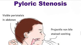 Pyloric Stenosis [upl. by Oilicec]