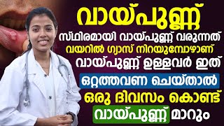 ഇത് ഒറ്റത്തവണ ചെയ്താൽ തന്നെ വായ്പുണ്ണ് ഒറ്റ ദിവസത്തിൽ മാറും  vaya punnu maran  Dr Juhi Das [upl. by Akerahs506]