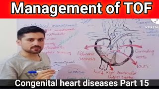 tetralogy of fallot management  blalock taussig shunt  waterston shunt procedure  tof heart [upl. by Ahsiea369]