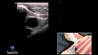 How To Ultrasound Guided Insertion of a Subclavian Vein Catheter 3D Video [upl. by Taggart]