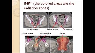 Cancer of the Vulva [upl. by Race]