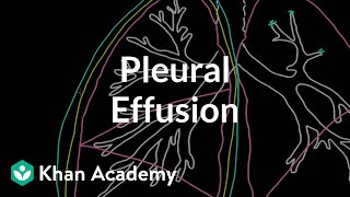 What is a pleural effusion  Respiratory system diseases  NCLEXRN  Khan Academy [upl. by Reynolds]