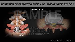 Posterior Discectomy amp Fusion of Lumbar Spine at L5S1 [upl. by Jehu]