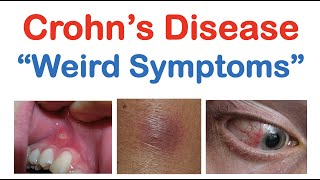 Crohn’s Disease Weird Symptoms  Atypical Clinical Features  Skin Mouth Joints Organ Systems [upl. by Carhart]