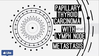 Papillary Thyroid Carcinoma with Lymph Nodes Metastasis [upl. by Robena]