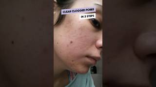 3 steps to clear cloggedpores [upl. by Eneleuqcaj]