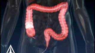 Colonoscopy  3D Medical Animation [upl. by Bouchier]