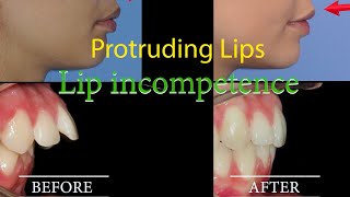 🔥 LIP INCOMPETENCE❗️ Lip protrusion BRACES Before and After timelapse [upl. by Adiaros693]