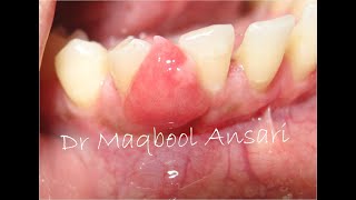 Excision of Gingival Epulis [upl. by Niobe247]