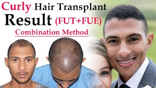 Curly Hair Transplant Results  Dr Suneet Soni  Medispa India Hair Transplant Jaipur [upl. by Tomkin]