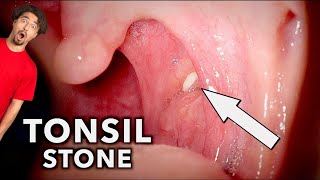 Tonsil Stones Removal Compilation  What Are Tonsil Stones [upl. by Eveneg]