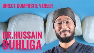 Direct composite veneer  DrHussain Buhliga [upl. by Iny684]