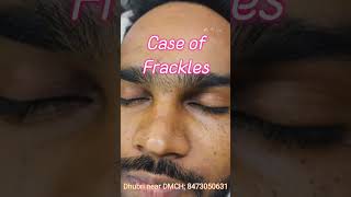 Freckles Laser removalDr Alamins Skin Hair amp Laser Clinic near dhubri medical college6901855020 [upl. by Marris]