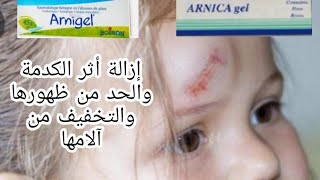 ضروري من حملها في حقيبة يدك أينما ذهبت،arnigelالحل الوحيد والفعال لتفادي الكدمات وعلاجها بسرعة [upl. by Josh704]