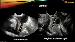 Gynaecological Ultrasound Step by Step Part 1 [upl. by Nylarad779]