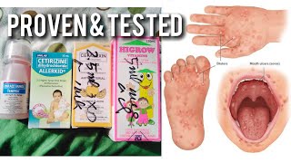 Gamot sa Hand foot and mouth disease ni baby babytips hadndfootandmouthdisease [upl. by Florance623]