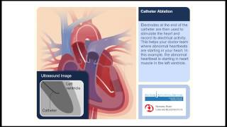 Catheter Ablation Animation Video [upl. by Carolan]