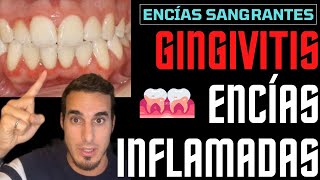 GINGIVITIS TRATAMIENTO y SÍNTOMAS  ENCIAS INFLAMADAS [upl. by Nadler]