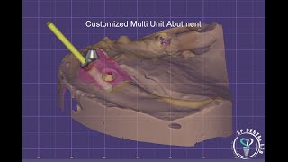 Customized Multi unit Abutment [upl. by Drucill264]