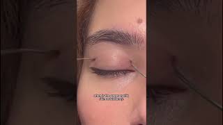 Upper Blepharoplasty  Upper Eyelid Surgery  NYC Plastic Surgeon  Facial Plastic Surgery [upl. by Nolyarg954]