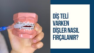 Diş teli varken dişler nasıl fırçalanır  Ortodontik tedavide ağız bakımı nasıl olmalı [upl. by Selina103]