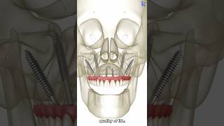 Zygomatic Implants Indications Drawbacks Benefits [upl. by Ennoval299]