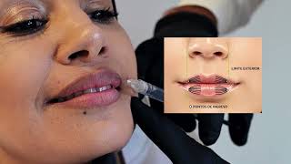 Tutorial Relleno de labios con técnica mixta VMC [upl. by Dreda477]