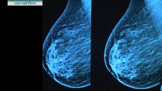 Martin Sonnenschein Tomosynthesis in routine mammography [upl. by Lessirg203]