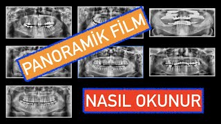 Panoramik Film Nasıl Okunur [upl. by Daenis548]