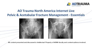 Pelvic amp Acetabular Fracture Management Essentials WEEK 2 [upl. by Spanjian286]