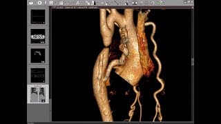 CT Angiography Case06 Coarctation of Aorta [upl. by Riane]