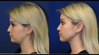 ChinNeck Liposuction Before  After  Nashville Plastic Surgeon [upl. by Anitnuahs]