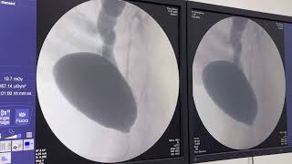 Uretrocistografia retrógrada miccional UCM em paciente com Refluxo vésico ureteral [upl. by Stella458]