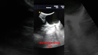 Bartholins gland cyst [upl. by Eittel678]