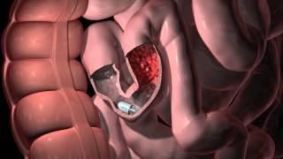 PillCam SB 3 Animation  GI Tract Abnormalities [upl. by Clemente818]