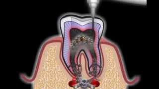 Wurzelbehandlung beim Zahnarzt [upl. by Bashemath]