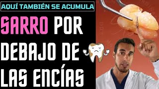 El SARRO DENTAL también se acumula por debajo de las ENCÍAS  Esto te puede pasar [upl. by Annaoj]