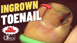 Extreme Closeup Ingrown Toenail Removal  Dr Nick Campitelli [upl. by Anerat]