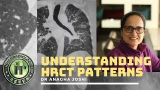 Understanding Lung HRCT patterns  Dr Anagha Joshi  Nodules amp Septal Thickening [upl. by Chantalle]