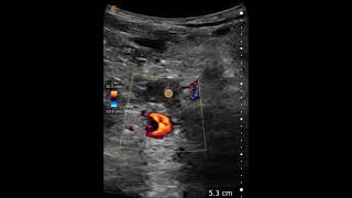 Popliteal Deep Venous Thrombosis  Ultrasound Image Interpretation [upl. by Nodaj829]