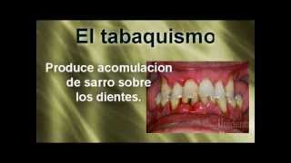 Como afecta el Tabaquismo a los dientes [upl. by Sucrad81]