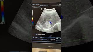 Hepatic Mets  Hemangioma ultrasound sonography hemangioma liver mets hepatic [upl. by Ettenawtna292]