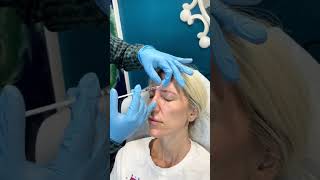 Xeomin Injections At Palm Beach  Xeomin Smart Toxin Injection shorts youtubeshort xeomin [upl. by Los]