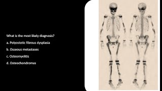 Fibrous Dysplasia MCQs SCFHS bonescan nuclearmedicineMCQ nuclearmedicine frcr bonescan [upl. by Eillak]