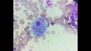 Sea Blue Histiocyte It’s a macrophage Has ceroid and lipofuscin granules in its cytoplasm [upl. by Konopka]